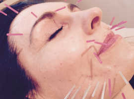 Collagen Facial Tightening with Facial Acupuncture