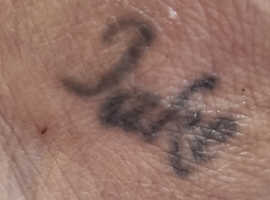 Laser Tattoo Removal