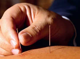 Acupuncture in London China town Holborn