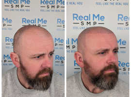 Scalp Micro-pigmentation. #1 Hair Transplant alternative
