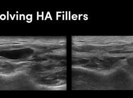 Dissolving unwanted filler under ultrasound
