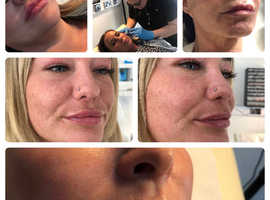 1ml lip filler introductory offer
