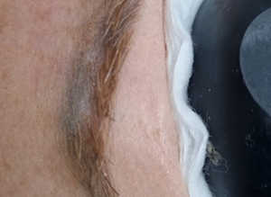 Tattoo removal
