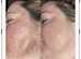 PRP hair growth and facial treatments injections