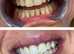 Cosmetic lazer teeth whitening