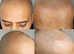 Bald? Thinning hair? Receding hairline? Why not consider scalp micropigmentation?