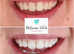 Professional Laser Teeth Whitening