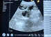 Ultrasound & Microchipping